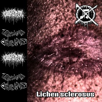 Casentrino & Terminal Dissection - Lichen Sclerosus (2026)