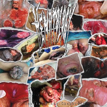 Hematology - Genital Ulcer-Chancroid (2026)