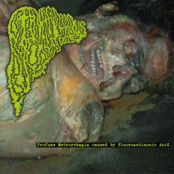 Gangrenous Necrosis - Profuse Metrorrhagia Caused by Fluoroantimonic Acid (2026)
