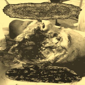 Hydroencephalocystocele / Encephalomyeloradiculoneuropathy - Split (2026)