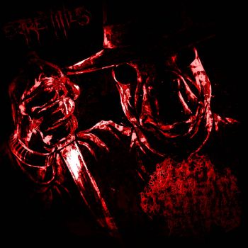 Necrotizing Fasciitis - Extremities (2026)