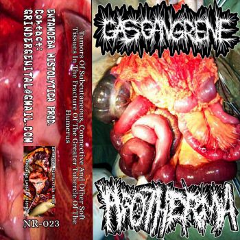 Gas Gangrene / Hypothermia - Tumors of Subcutaneous, Connective and Other Soft Tissues in the Fracture of the Greater Tubercle of the Humerus (2026)
