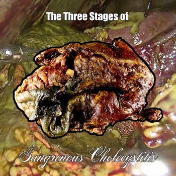 Gangrenous Cholecystitis - The Three Stages of Gangrenous Cholecystitis (2026)