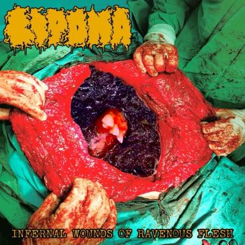 Lipoma - Infernal Wounds of Ravenous Flesh (2026)