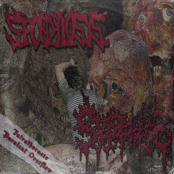 Syphilis / Spondylosys - Intrathoracic Purulent Overflow (2026)
