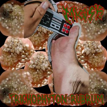 Micosis - Trichophyton Rubrum (2026)