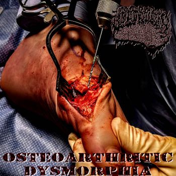 Bunionectomy - Osteoarthritic Dysmorphia (2026)