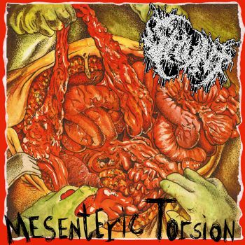 Shunt - Mesenteric Torsion (2026)